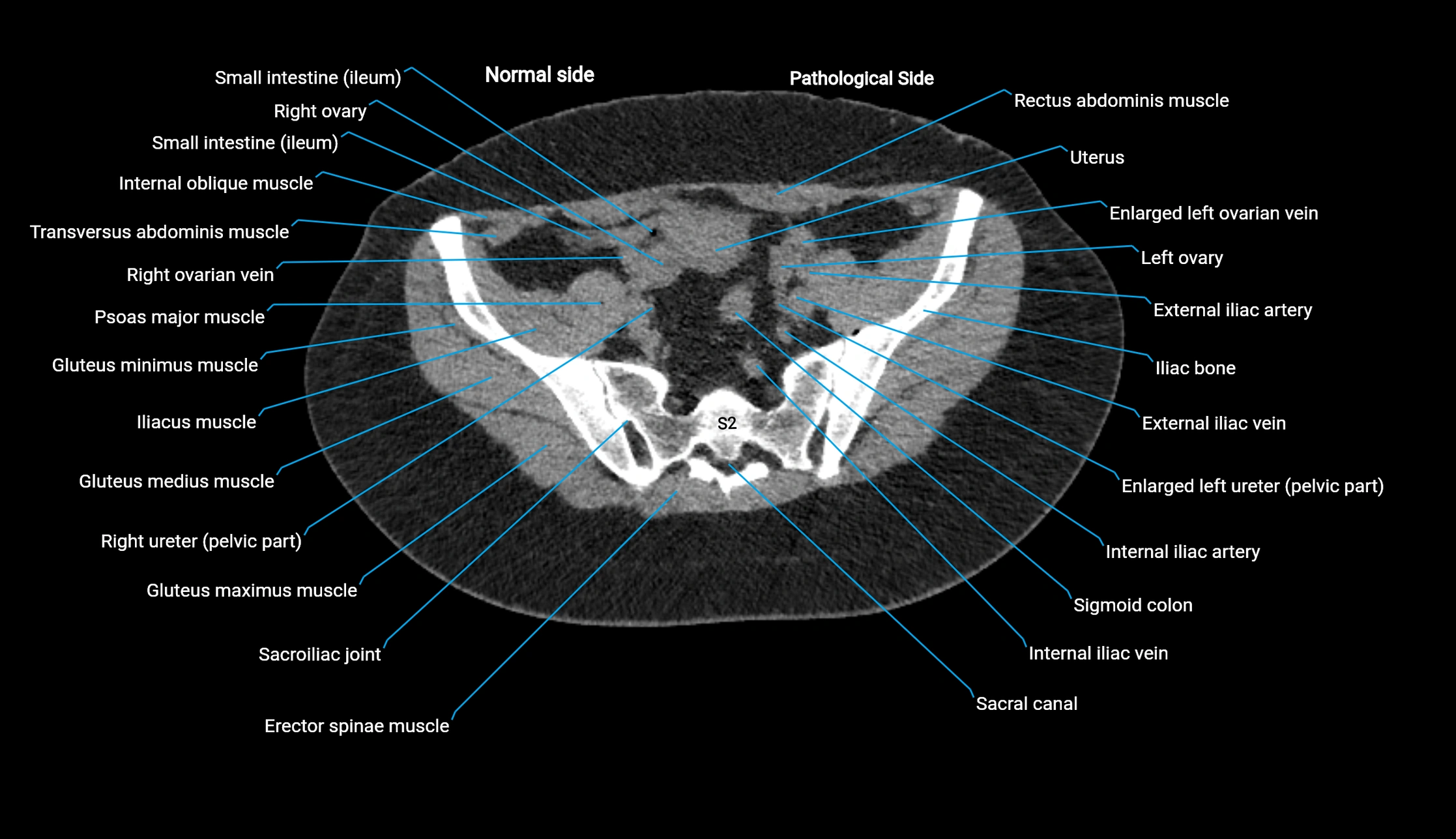 CT KUB axial cross sectional anatomy  radiology image -img-00201-00124.webp